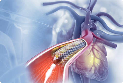 Interventional Cardiology